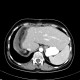Metastasis of tubular carcinoma of large bowel, colorectal carcinoma, hemihepatectomy: CT - Computed tomography